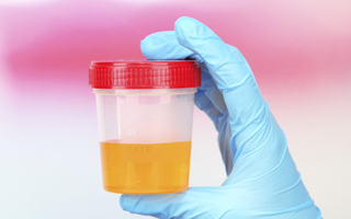 Kann man harnsäure im urin messen?